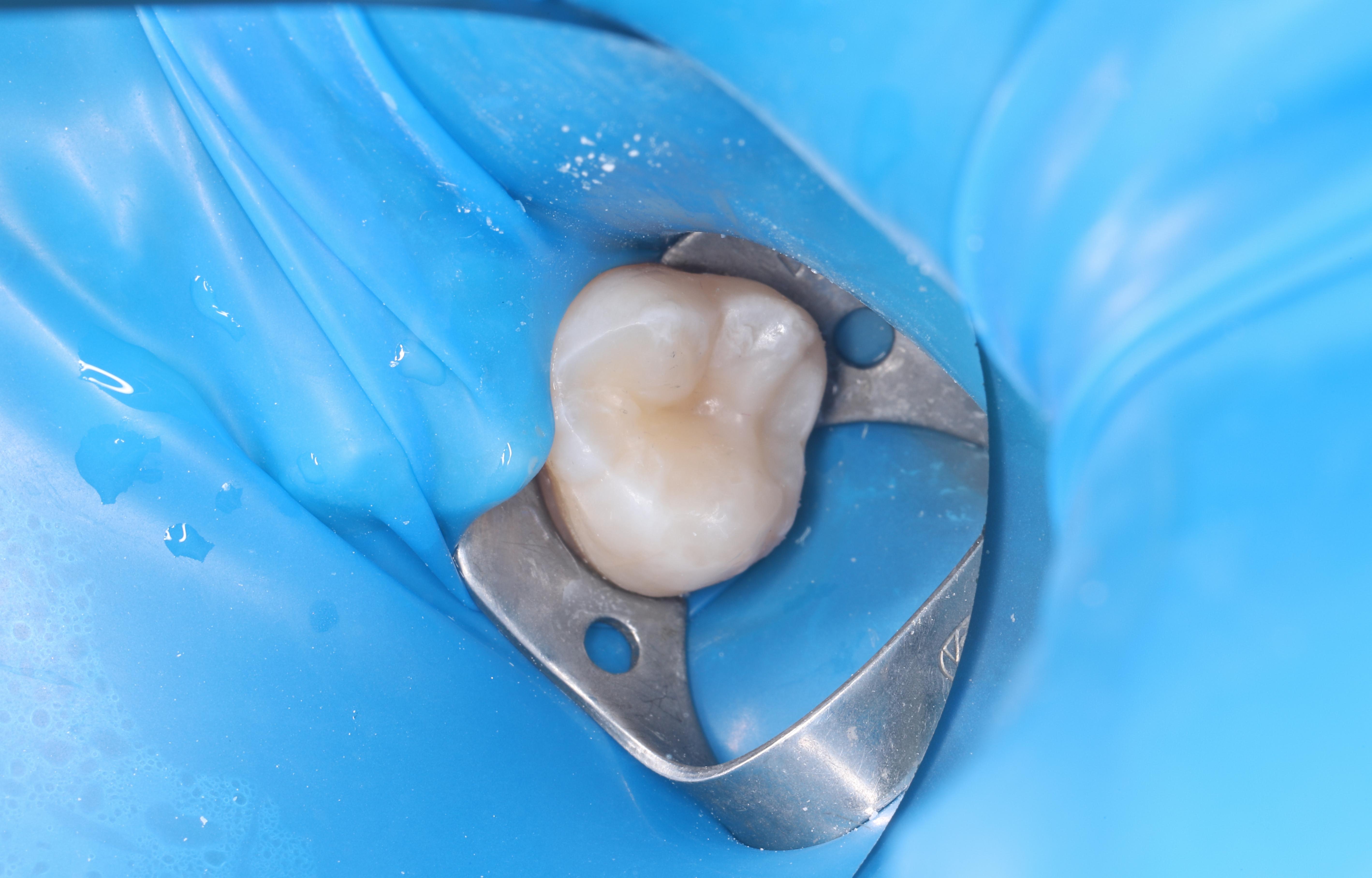 Лечение кариеса