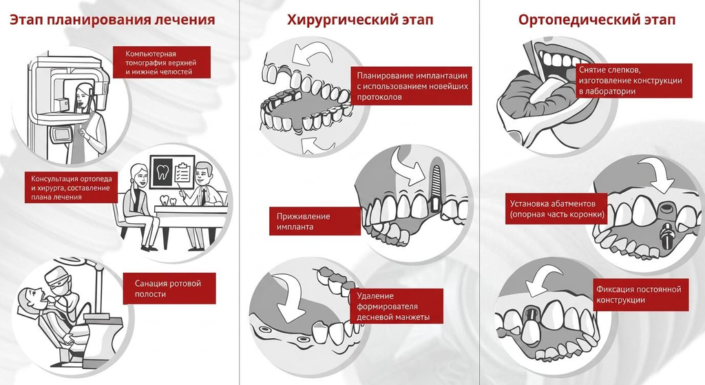 Этапы имплантации.png