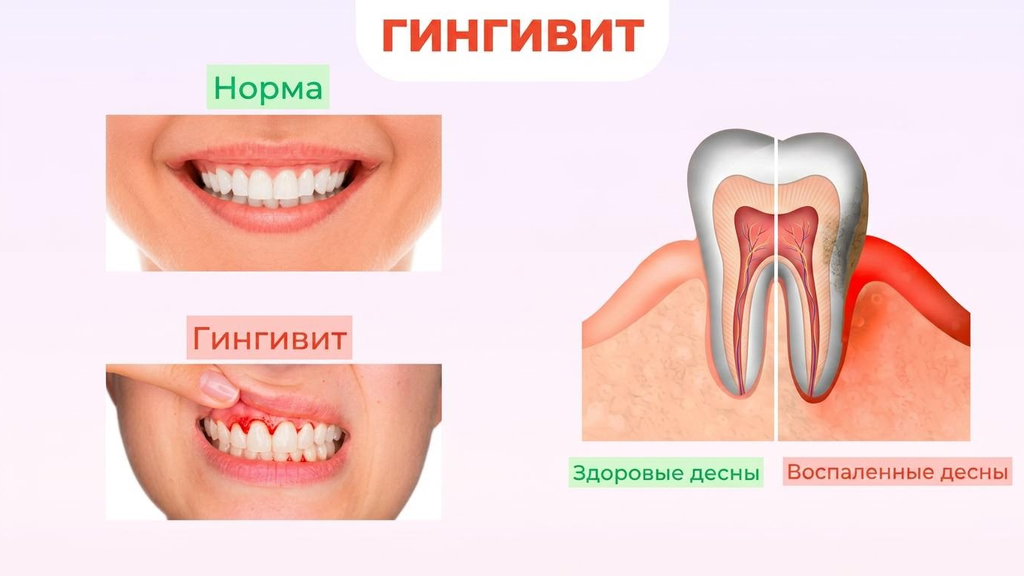 Лечение гингивита у детей Лечение гингивита у детей